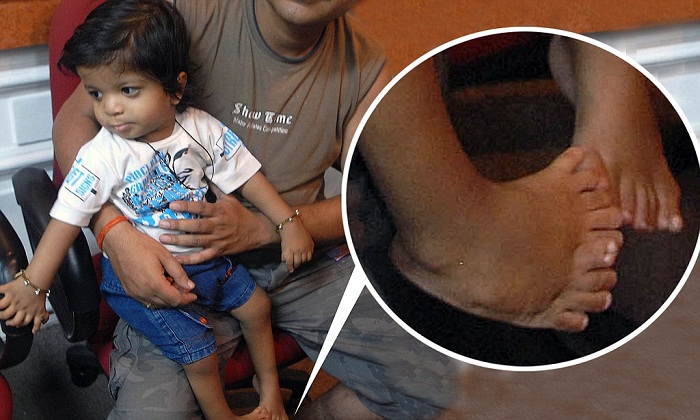 Akshat, a baby boy over the age of one, registered his name in the Guinness world records for having a total of 34 fingers and toes